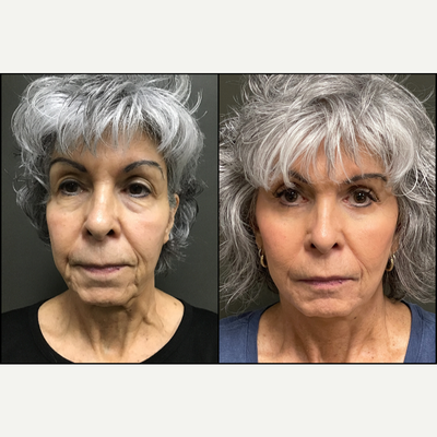 Facelift before and after photo
