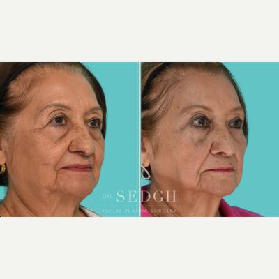 Eyelid Surgery before and after photo