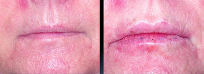 Juvederm before and after photo