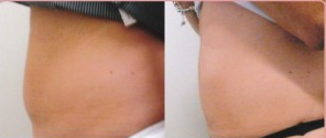 CoolSculpting before and after photo