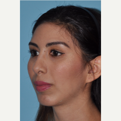 Dr. Richard Zoumalan, Top Nose Job Doctor and Surgeon in CA, Best Natural  Ethnic Rhinoplasty and Septoplasty Surgery LA, Buccal Fat Removal, Chin  Implant, Non-Surgical Facelift and Necklift Specialist with Good Results