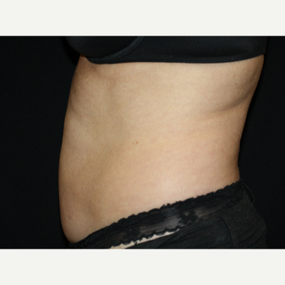CoolSculpting for C Section Pouch - Reston Dermatology + Cosmetic