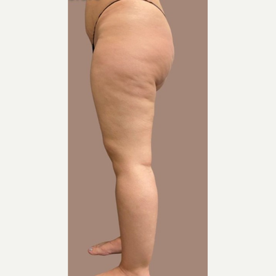 Specialized Liposuction Is Shown to Prevent Lipedema Progression