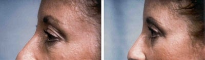 Eyelid Surgery before and after photo