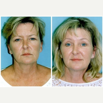 Eyelid Surgery before and after photo