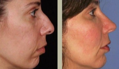 Rhinoplasty before and after photo