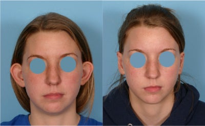 Ear Surgery before and after photo