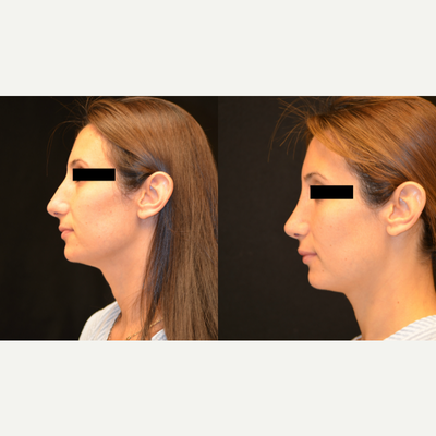 Rhinoplasty before and after photo