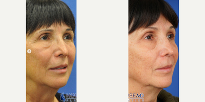 Woman treated with Restylane Contour, Brow Lift - She is now 2 weeks post @Botoxcosmetic to the crow's feet (chemical browlift) and platysma, and @Restylaneusa HA filler to the cheeks, nasolabial folds, and Ristow's space (to address age-related bone loss of the midface). She was also stared on a @zoskinhealth regimen to help with pigmentation and fine lines/wrinkles, and is loving her refreshed look! 
