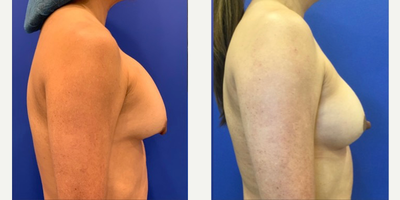 55-64 year old woman treated with Breast Implant Revision - The techniques used in this case included: 1. Removal of the implants2. Removal of all of the scar tissue inside of the breasts (this is called capsulotomy and capsulectomy)3. Inserting a new implant 4. Occasionally, I have to reposition the implant under the chest muscle, if it was placed over the muscle initially. 5. Covering the implant with a sheet of collagen to prevent future capsular contracture. Capsular contracture occurs when the scar tissue around the implant becomes hard and tightens around the implant. 6. I sometimes add a mesh specifically designed for the breast. This acts as an internal bra to hold the breasts up in a higher position and prolongs the longevity of the result. This material is very safe. It is absorbed by the body over time and is replaced with scar tissue which acts as the new internal bra. 7. Many patients also need a mastopexy or breast lift if the breasts are very asymmetric or saggy in appearance. The type of mastopexy depends on the amount of loose skin present. The options include a circumareolar mastopexy (donut lift), vertical mastopexy (lollipop lift) and full mastopexy (anchor scar lift). 8. Lastly, I will occasionally recommend fat grafting to the breasts to fill in areas that need it. Some patients choose to replace their volume with fat instead of an implant. Which steps or techniques are used depends on each patient's specific case. Some patients need only a few of the above steps and some patients require all of the above steps to achieve the best results. The plan is customized for each patient to deliver the best and most beautiful results possible.
