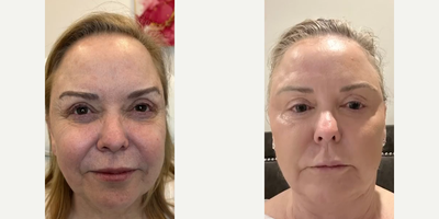 Woman treated with Facial, Halo Laser, CO2 Laser - Woman treated with Facial, Halo Laser, CO2 Laser