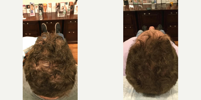 PRP for Hair Loss - RP AND HAIR LIGHT RESTORATION
