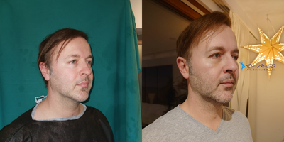 35-44 year old man treated with Cheek Implants - For lower infection risk versus an intraoral approach, implants were placed transconjunctivally and were fixated with two screws to avoid implant mobilization risk.