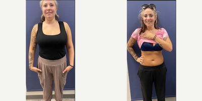 18-24 year old woman treated with Semaglutide for Weight Loss - Start Weight - 132.8Start Date - 04/20/23End Weight - 108.4End Date - 07/20/23Client has finished program and has maintained her weight loss and continues to weight train 5x a week.