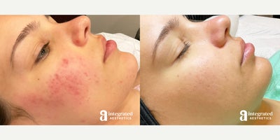 18-24 year old woman treated with Laser Genesis - The patient is a 24-year-old female who had concerns with acne and acne scarring. Shereceived a series of laser genesis treatments over the course of about 6 months.