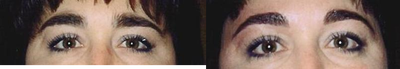 Eyebrow Design with Electrolysis- Permanent Hair Removal - Eyebrows specifically shaped by Electrolysis to give perfect lifelong shape and definition. No more tweezing, waxing or misshapen brows again!