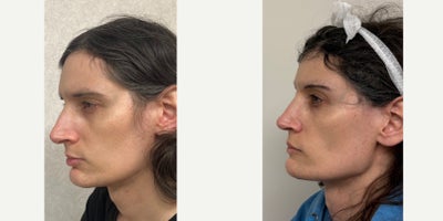 25-34 year old woman treated with Adam's Apple Reduction, Rhinoplasty, Forehead Reduction, Brow Bone Reduction, Genioplasty, Fac - this is a young lady who had forehead feminization, septorhinoplasty, and chin feminization.
