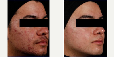 Man treated with AviClear - Man treated with AviClear.