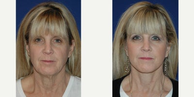 55-64 year old woman treated with Facelift - Lateral SMASectomy facelift with platysmaplasty neck lift.