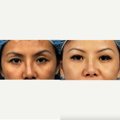 35-44 year old woman treated with Asian Eyelid Surgery - Upper eyelid surgery was performed to improve crease symmetry and definition, and fat grafting to upper eyelid was performed to reduce hollowing and deflation