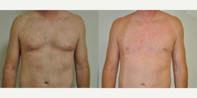Man treated with Gynecomastia Surgery - Man treated with Gynecomastia Surgery