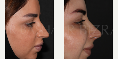 Woman treated with Sinus Surgery - Blocked Nose