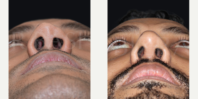 Woman treated with Sinus Surgery - Blocked Nose
