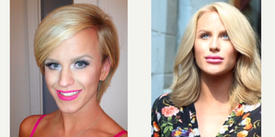25-34 year old woman treated with Facial Feminization Surgery - 25-34 year old woman treated with Facial Feminization Surgery