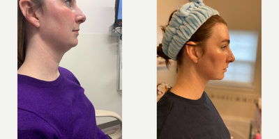 35-44 year old woman treated with Facelift - Double Chin Surgery