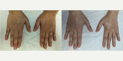 25-34 year old woman treated with Hand Rejuvenation, Radiesse, Juvederm - Hand rejuvenation with dermal filler injection (Radiesse, Juvederm) using micro-cannula technique