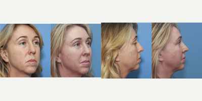 45-54 year old woman treated with Silhouette InstaLift - 3 threads per side for improvement of lower face and jawline