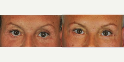 55-64 year old man treated with Eyelid Retraction Repair - Lower eyelid retraction repair: Endoscopic subperiosteal mid-facelift through temporal incision + posterior lamella reconstruction with spacer (hard palate mucosa) graft  + Lateral cathoplasty