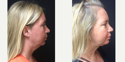 35-44 year old woman treated with Neck Lift - Patient had a Lazerlift performed