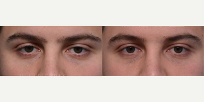 18-24 year old man treated with Voluma, Restylane, Restylane Lyft, Restylane Defyne, Juvederm - A man in his 20s, after 1 session of Ezgel PRF to under eye hollows. This is typically done in a series of three sessions.