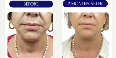 45-54 year old woman treated with Diluted Radiesse - Collagen biostimulation with DILUTED RADIESSEHyperdiluted Radiesse is Radiesse that has been diluted with a mixture of sterile saline solution and lidocaine. This makes it an easily spreadable bio stimulator capable of remodeling skin over a larger area. Hyperdiluted Radiesse is injected into areas of the skin that are loose as opposed to firm and stimulates the body to create new collagen. It is used to address concerns related to skin texture and laxity, such as fine wrinkles, creepiness, acne scars, cellulite, and saggy skin.