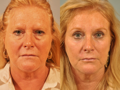 Complete Transformation - 
	Performed a brow lift, upper and lower blephroplasty, and a lower eye lid resurfacing Hetter peel.
