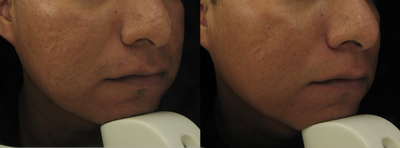 25-34 year old man treated with Intracel - 25-34 year old man treated with 3 series ofIntracel