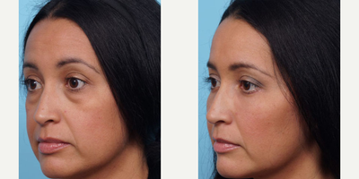 Woman treated with Eyelid Surgery - Dr. Balikian preformed a Lower Blepharoplasty with fat transfer to her lower eyes and cheeks 1 month ago. She still has plenty of healing to do, but her overall her results are great so far