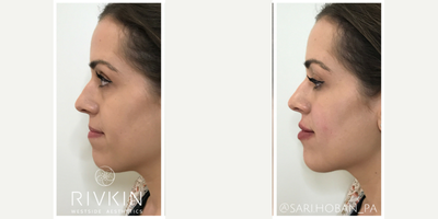 Restylane Refyne for the Lips - Many people would think this patient has received chin filler based on her before and afters when in fact all she had was a little lip filler! For lips the correct proportion is that the top lip be 1/3rd the size of the bottom lip. Adding a little bit of filler to correct the proportions of her lips also changes the shape of her face!