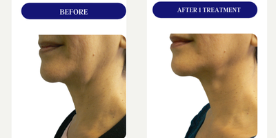 45-54 year old woman treated with Fractora RF, Forma, Facial, Skin Tightening, Skin Rejuvenation - FRACTORA FIRM-FORMAbipolar radiofrequency
