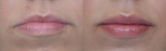 Restylane Injections for Lip Augmentation - Restylane Injections for Fuller, Natural-Looking Lips&nbsp;