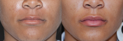Restylane - Restylane on upper and lower lips.