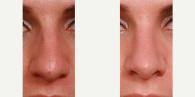 25-34 year old woman treated with Rhinoplasty for twisted large nose and hanging tip - This woman consulted with Dr. Holden for a larger nose that was crooked and hooked down, especially when she smiled. Dr. Holden performed this woman's rhinoplasty to decrease the overall size of her nose, straighten it out. He built support for her nose tip to keep turn it up and keep it from pulling down when she smiled.