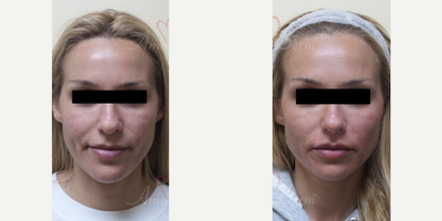 35-44 year old woman treated with Thread Lift - Liquid Facelift with PDO Thread (thread lift) in mid and lower face (nasolabial folds, marionette lines, jaw lines)