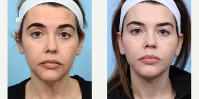 35-44 year old woman treated with Deep Plane Facelift, Facial Fat Transfer - Dr. Wise performed a deep plane facelift and facial fat transfer to remove loose skin, tighten the neck and face, as well as adding volume to the mid-face. The results of these procedures combined show a more youthful, refreshed appearance.