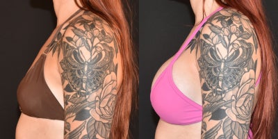 25-34 year old woman treated with Breast Augmentation, Sientra Breast Implants - 285cc Sientra Smooth Round Implants