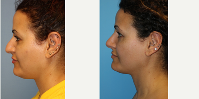 25-34 year old woman treated with Rhinoplasty - This young woman presented with a crooked, broad nose with a hump and down-pointing tip. She also had difficulty breathing and was on flonase for 5 years prior to her operation. She desired a natural looking nose that did not look overdone. She did not want a scooped out nose and did not want to completely lose her ethnic appearance. She is extremely pleased with her rhinoplasty results. Furthermore, she is off the flonase and is breathing better then ever.