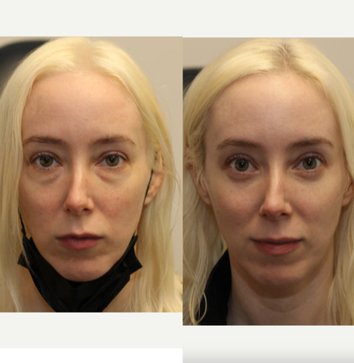 Transconjunctival lower blepharoplasty for eye bags - Dr. Kotlus performed lower eyelid surgery to remove bags and reposition fat to the under-eye hollows.