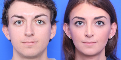 25-34 year old woman treated with MTF Facial Feminization Surgery - Brow lift, Brow Bone Reduction with Hairline Advancement, Lip Lift, Mandible Contouring, Rhinoplasty with Septoplasty.