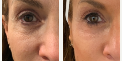 45-54 year old woman treated with Plasma Pen - Repair of crepey skin under eyes post removal of filler with hyaluronidase. This is 3 weeks post procedure.